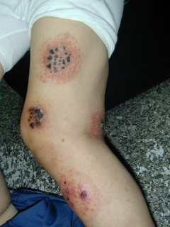 صوره توضيحية عن الحجامة Misuse,cupping(010921-1)