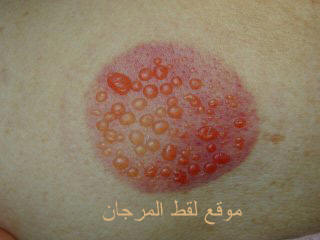 أنواع الحجامة وطريقة عملها  Misuse,cupping(020809)